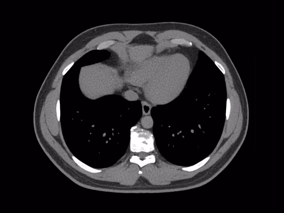 Low-dose lung CT screening