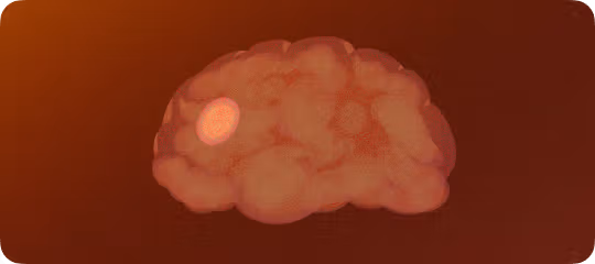 Understanding brain tumor symptoms: common signs and misconceptions
